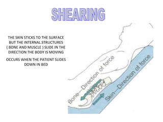 THE SKIN STICKS TO THE SURFACE
BUT THE INTERNAL STRUCTURES
( BONE AND MUSCLE ) SLIDE IN THE
DIRECTION THE BODY IS MOVING
OCCURS WHEN THE PATIENT SLIDES
DOWN IN BED
 