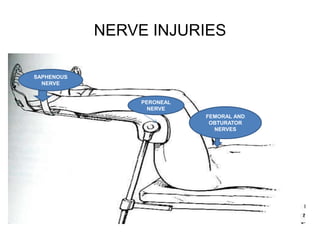 NERVE INJURIES
SAPHENOUS
NERVE
PERONEAL
NERVE
FEMORAL AND
OBTURATOR
NERVES
 