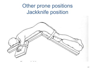 Other prone positions
Jackknife position
42
 