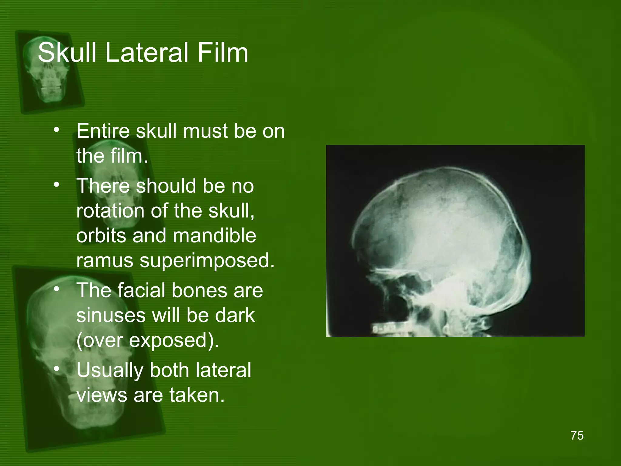 Positioning and radiographic anatomy of the skull | PPT