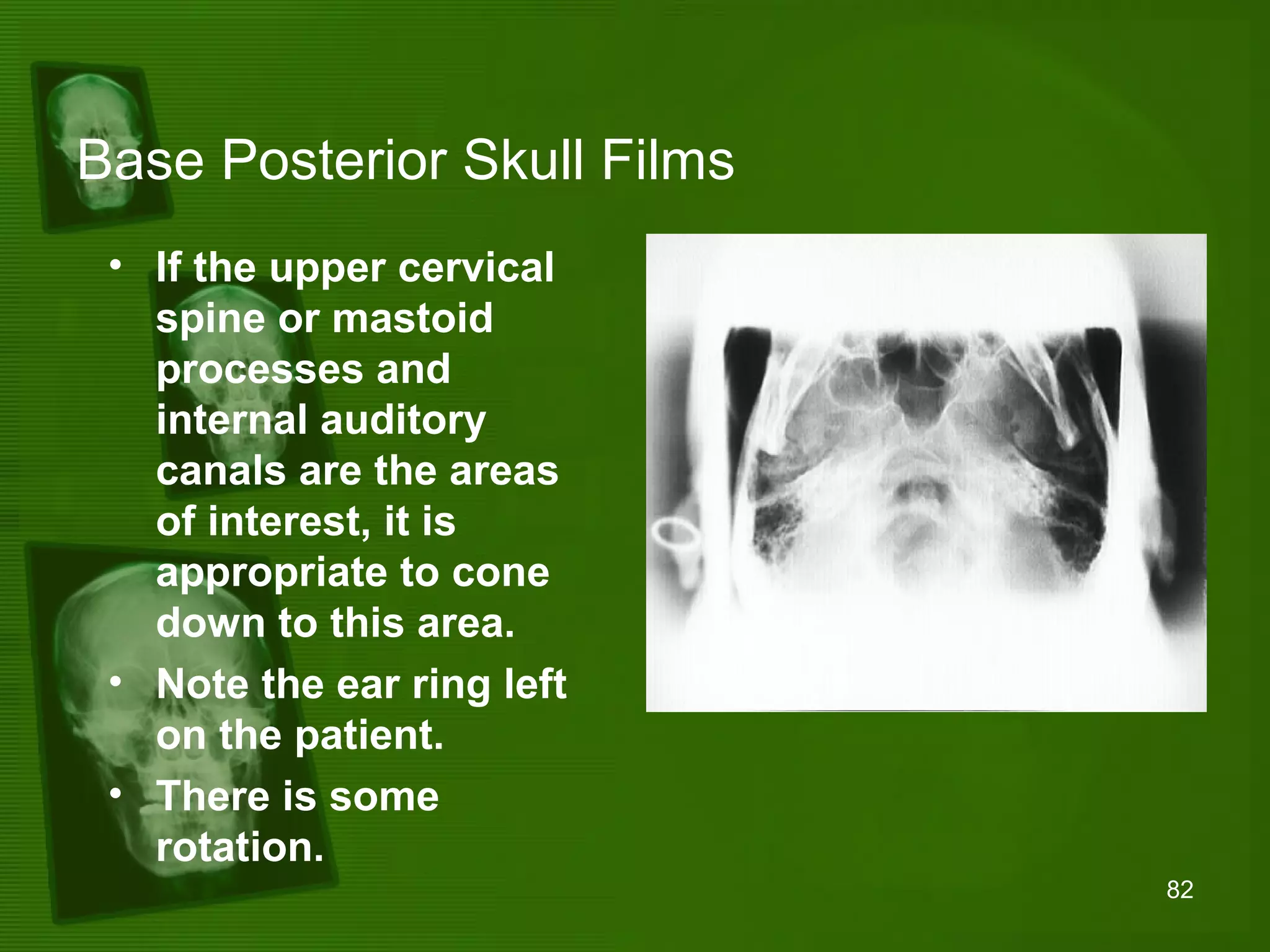Positioning and radiographic anatomy of the skull | PPT