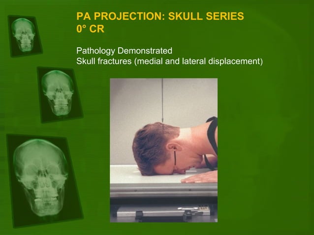 Positioning and radiographic anatomy of the skull | PPT | Bone and ...