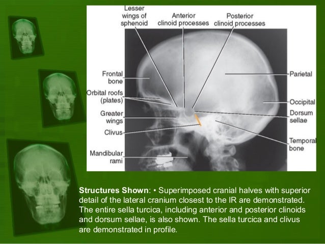 Image result for lateral skull radiograph anatomy