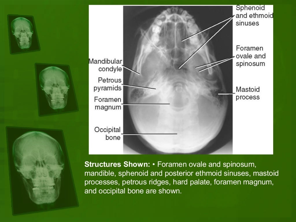 Positioning and radiographic anatomy of the skull