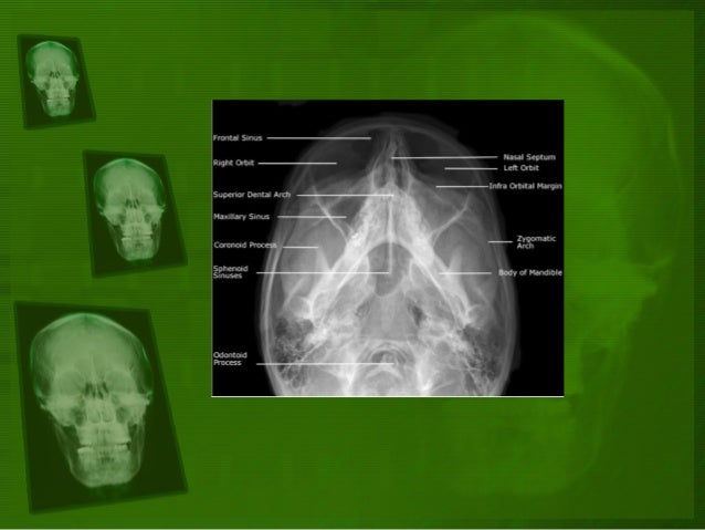Positioning And Radiographic Anatomy Of The Skull Positioning And Radiographic Anatomy Of The Skull