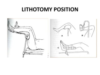 LITHOTOMY POSITION
 