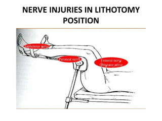 NERVE INJURIES IN LITHOTOMY
POSITION
 