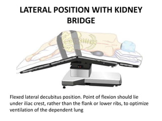 LATERAL POSITION WITH KIDNEY
BRIDGE
Flexed lateral decubitus position. Point of flexion should lie
under iliac crest, rather than the flank or lower ribs, to optimize
ventilation of the dependent lung
 