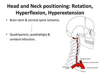 Head and Neck positioning: Rotation,
Hyperflexion, Hyperextension
• Brain stem & cervical spine ischemia.
• Quadriparesis, quadriplegia &
cerebral infarction.
 