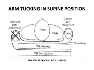 ARM TUCKING IN SUPINE POSITION
TO PREVENT BRACHIAL PLEXUS INJURY
 