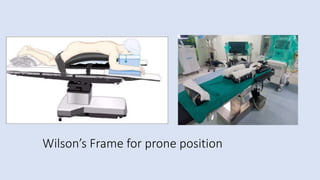 Wilson’s Frame for prone position
 