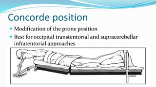 Concorde position
 Modification of the prone position
 Best for occipital transtentorial and supracerebellar
infratentorial approaches
 