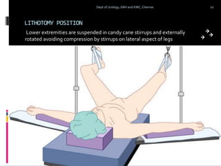 LITHOTOMY POSITION
Lower extremities are suspended in candy cane stirrups and externally
rotated avoiding compression by stirrups on lateral aspect of legs
11
Dept of Urology, GRH and KMC, Chennai.
 