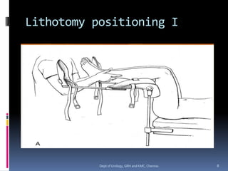 Lithotomy positioning I
8
Dept of Urology, GRH and KMC, Chennai.
 