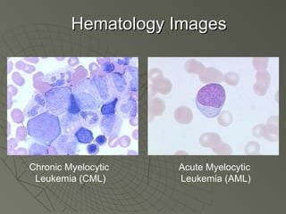 Hematology Images




Chronic Myelocytic   Acute Myelocytic
 Leukemia (CML)      Leukemia (AML)
 