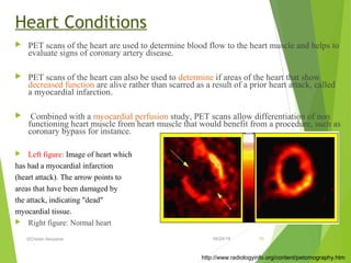 Positron emission Tomography (PET) | PPT