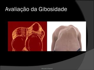 Mazzola & Zaparoli
Avaliação da GibosidadeAvaliação da Gibosidade
 