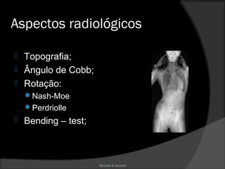 Mazzola & Zaparoli
Aspectos radiológicos
 Topografia;
 Ângulo de Cobb;
 Rotação:
Nash-Moe
Perdriolle
 Bending – test;
 