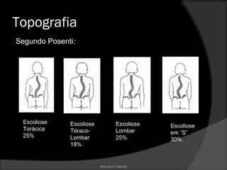 Mazzola & Zaparoli
Topografia
Escoliose
Torácica
25%
Escoliose
Tóraco-
Lombar
19%
Escoliose
Lombar
25%
Escoliose
em “S”
30%
Segundo Posenti:
 