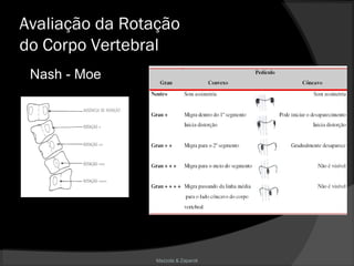 Mazzola & Zaparoli
Avaliação da Rotação
do Corpo Vertebral
Nash - Moe
 