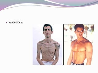  МАНОРЕКСИЈА
 