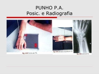 PUNHO P.A.
Posic. e Radiografia
 