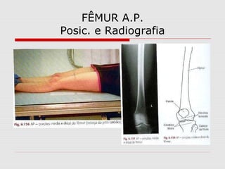 FÊMUR A.P.
Posic. e Radiografia
 