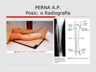 PERNA A.P.
Posic. e Radiografia
 