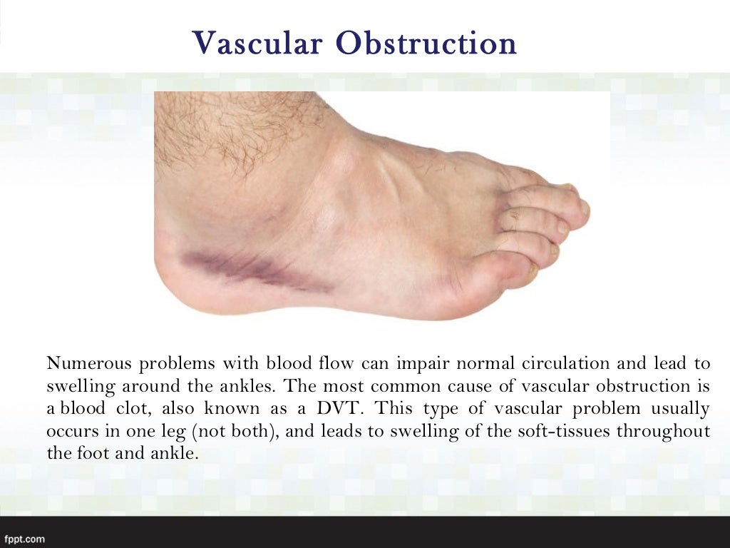 Possible causes of swollen ankle