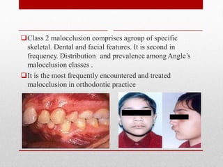Class 2 malocclusion comprises agroup of specific
skeletal. Dental and facial features. It is second in
frequency. Distribution and prevalence amongAngle’s
malocclusion classes .
It is the most frequently encountered and treated
malocclusion in orthodontic practice
 