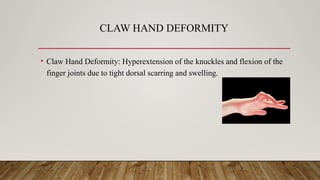 CLAW HAND DEFORMITY
• Claw Hand Deformity: Hyperextension of the knuckles and flexion of the
finger joints due to tight dorsal scarring and swelling.
 