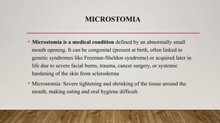 MICROSTOMIA
• Microstomia is a medical condition defined by an abnormally small
mouth opening. It can be congenital (present at birth, often linked to
genetic syndromes like Freeman-Sheldon syndrome) or acquired later in
life due to severe facial burns, trauma, cancer surgery, or systemic
hardening of the skin from scleroderma
• Microstomia: Severe tightening and shrinking of the tissue around the
mouth, making eating and oral hygiene difficult.
 