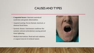 CAUSES AND TYPES
• Congenital factors: Inherited craniofacial
syndromes and genetic abnormalities.
• Acquired scarring: Severe thermal, electrical, or
chemical facial burns.
• Systemic disease: Autoimmune conditions like
systemic sclerosis (scleroderma) causing perioral
tissue tightening.
• Medical interventions: Head and neck radiation,
or surgical removal of orofacial tumors
 