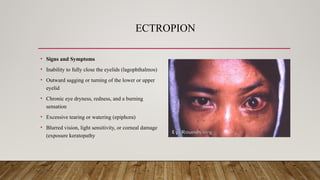 ECTROPION
• Signs and Symptoms
• Inability to fully close the eyelids (lagophthalmos)
• Outward sagging or turning of the lower or upper
eyelid
• Chronic eye dryness, redness, and a burning
sensation
• Excessive tearing or watering (epiphora)
• Blurred vision, light sensitivity, or corneal damage
(exposure keratopathy
 