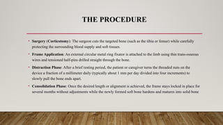 THE PROCEDURE
• Surgery (Corticotomy): The surgeon cuts the targeted bone (such as the tibia or femur) while carefully
protecting the surrounding blood supply and soft tissues.
• Frame Application: An external circular metal ring fixator is attached to the limb using thin trans-osseous
wires and tensioned half-pins drilled straight through the bone.
• Distraction Phase: After a brief resting period, the patient or caregiver turns the threaded nuts on the
device a fraction of a millimeter daily (typically about 1 mm per day divided into four increments) to
slowly pull the bone ends apart.
• Consolidation Phase: Once the desired length or alignment is achieved, the frame stays locked in place for
several months without adjustments while the newly formed soft bone hardens and matures into solid bone
 