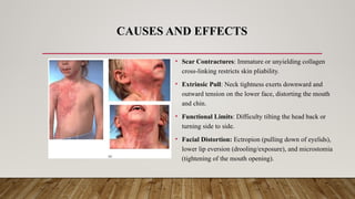 CAUSES AND EFFECTS
• Scar Contractures: Immature or unyielding collagen
cross-linking restricts skin pliability.
• Extrinsic Pull: Neck tightness exerts downward and
outward tension on the lower face, distorting the mouth
and chin.
• Functional Limits: Difficulty tilting the head back or
turning side to side.
• Facial Distortion: Ectropion (pulling down of eyelids),
lower lip eversion (drooling/exposure), and microstomia
(tightening of the mouth opening).
 