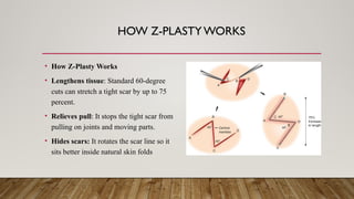 HOW Z-PLASTY WORKS
• How Z-Plasty Works
• Lengthens tissue: Standard 60-degree
cuts can stretch a tight scar by up to 75
percent.
• Relieves pull: It stops the tight scar from
pulling on joints and moving parts.
• Hides scars: It rotates the scar line so it
sits better inside natural skin folds
 