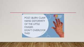 Comprehensive Overview of Post-Burn Deformities: Causes, Prevention, and Treatment
