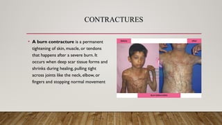 CONTRACTURES
• A burn contracture is a permanent
tightening of skin, muscle, or tendons
that happens after a severe burn. It
occurs when deep scar tissue forms and
shrinks during healing, pulling tight
across joints like the neck, elbow, or
fingers and stopping normal movement
 