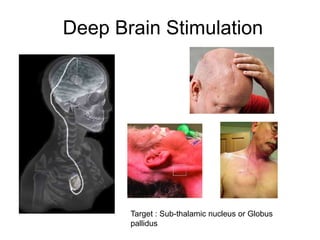 Deep Brain Stimulation
Target : Sub-thalamic nucleus or Globus
pallidus
 