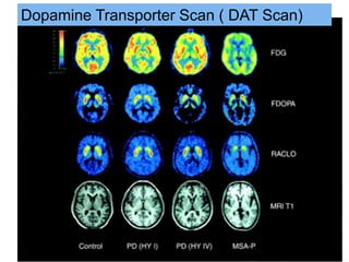 Dopamine Transporter Scan ( DAT Scan)
 