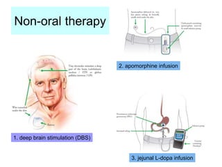 Non-oral therapy
1. deep brain stimulation (DBS)
2. apomorphine infusion
3. jejunal L-dopa infusion
 
