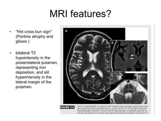 MRI features?
• "Hot cross bun sign"
(Pontine atrophy and
gliosis )
• bilateral T2
hypointensity in the
posterolateral putamen,
representing iron
deposition, and slit
hyperintensity in the
lateral margin of the
putamen.
 