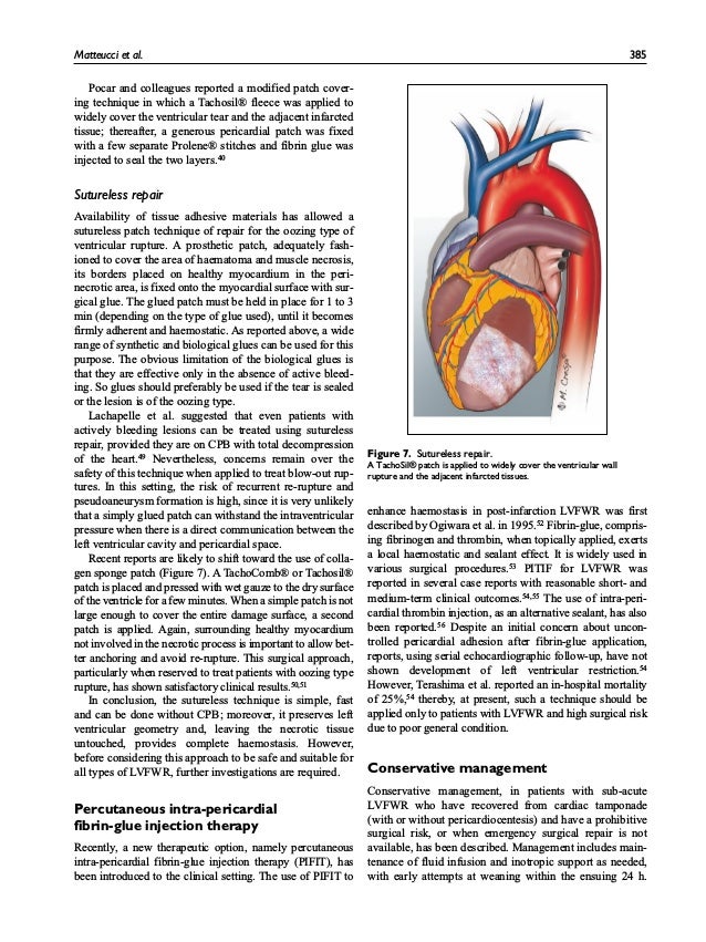 Post Infarction Left Ventricular Free Wall Rupture
