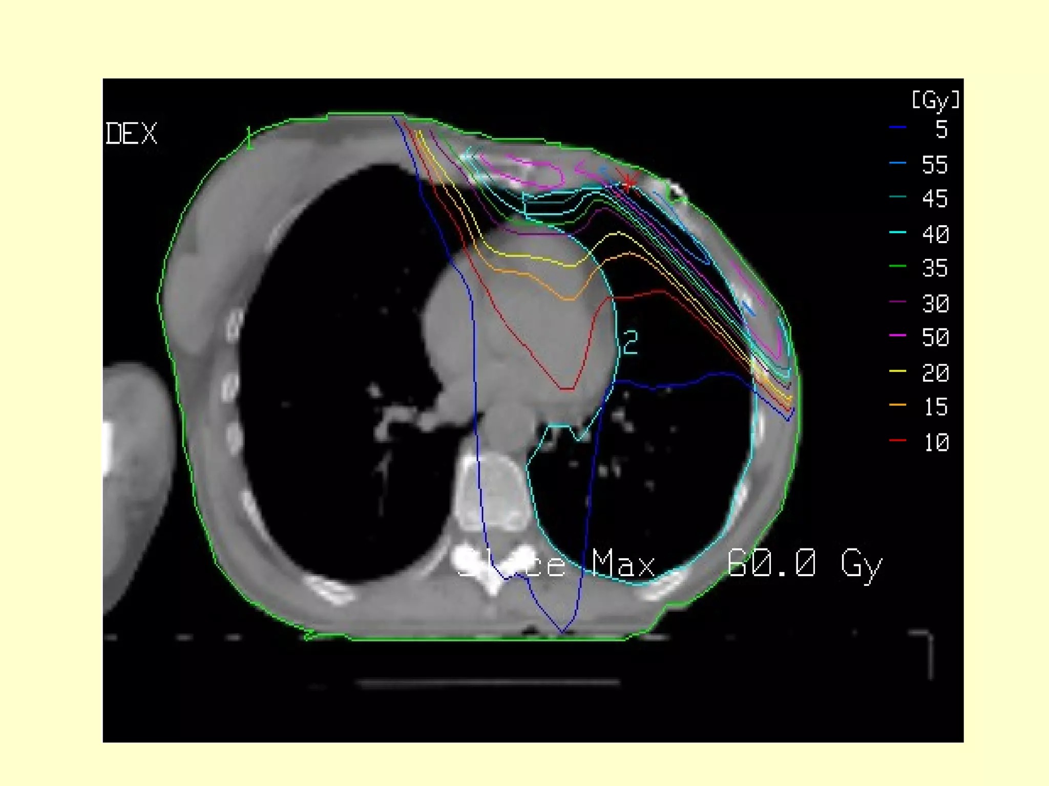 Post Mastectomy Radiotherapy | PPT