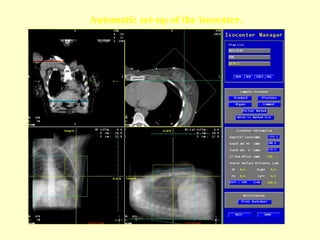 Isocenter Localization Post Mastectomy Radiotherapy | PPT