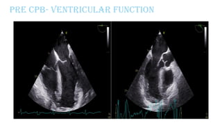 Pre CPB- Ventricular function
 