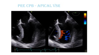 Pre CPB - Apical VSR
 