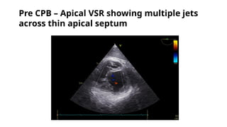 Pre CPB – Apical VSR showing multiple jets
across thin apical septum
 