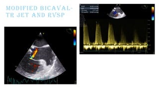 MODIFIED BICAVAL-
TR JET AND RVSP
 